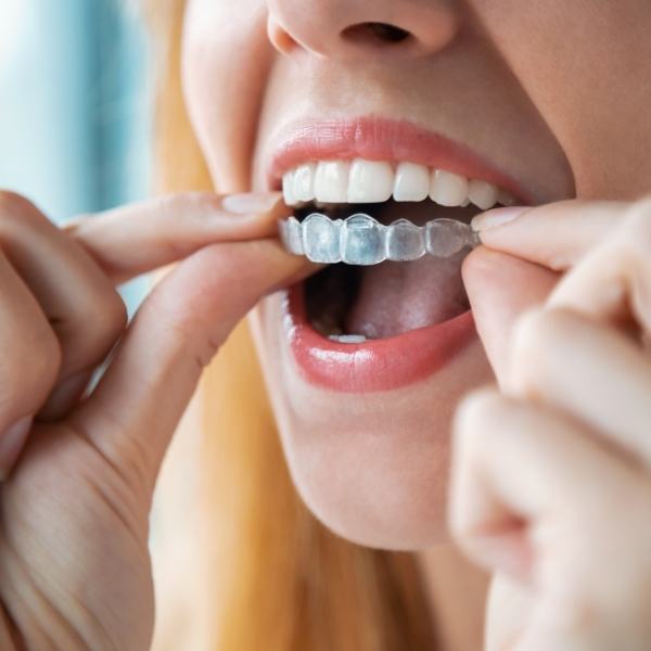Alinhadores Invisíveis: Dentes tortos nunca mais! - Stelle Odontologia